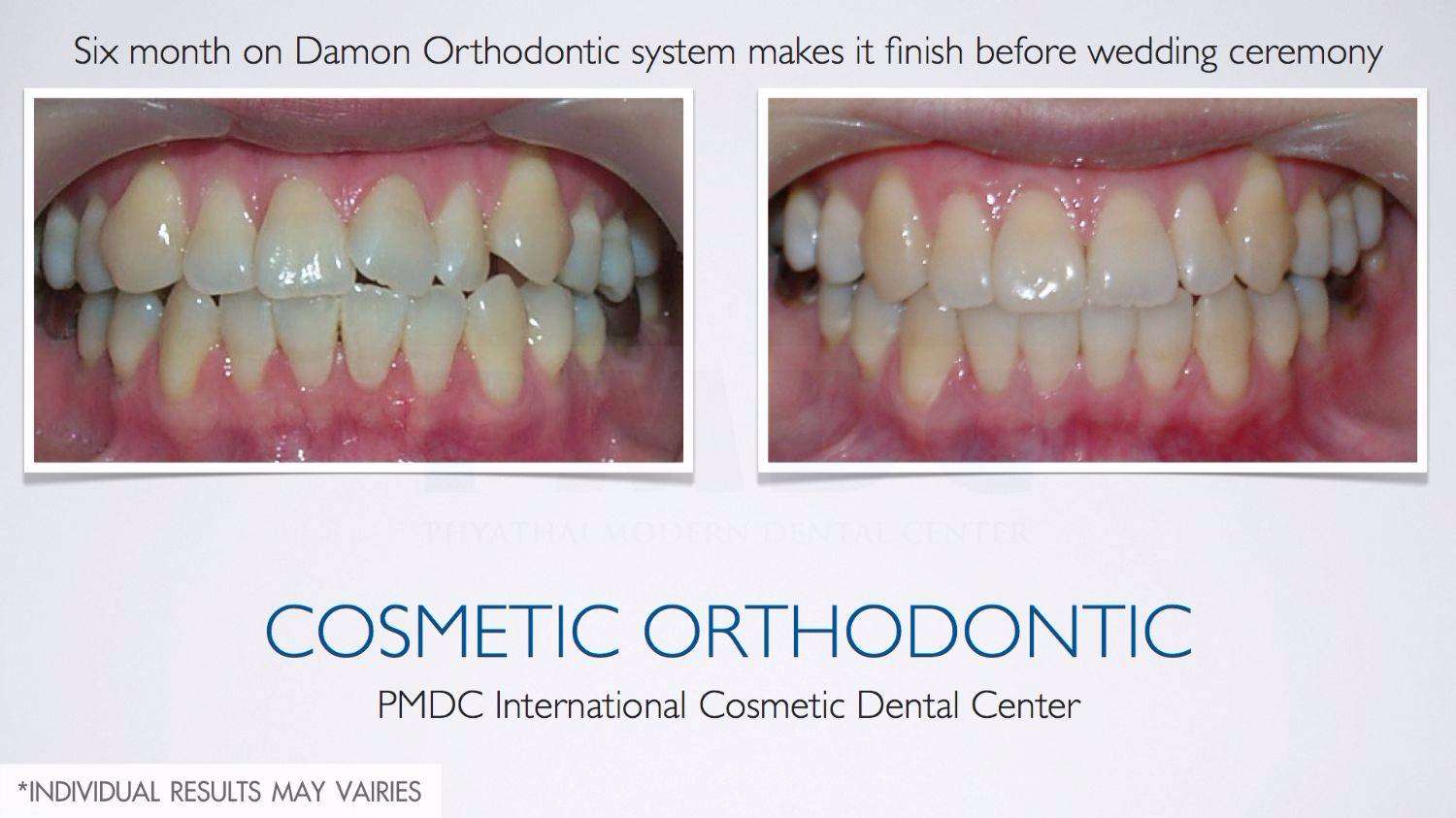 Cosmetic Orthodontic | PMDC Dental